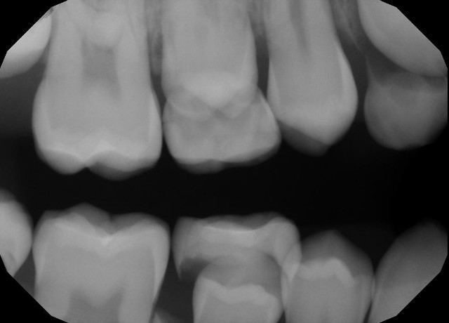 Decidous Tooth Extraction