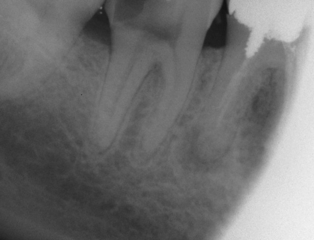 Molar Root Canal