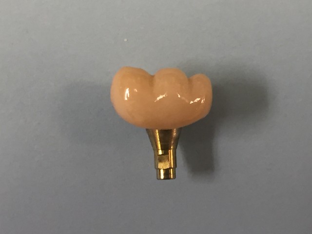 Screw retained implant crown
