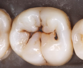 tooth #30 occlusal filling 