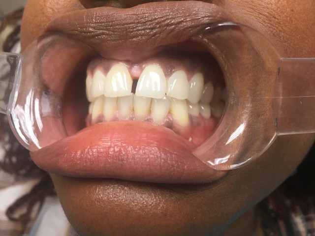 diastema